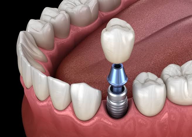 Dental Implants