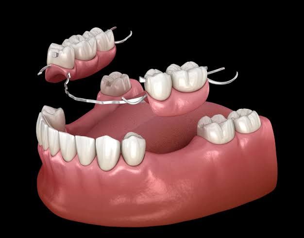 Prosthodontics (Replacement of Missing Teeth)